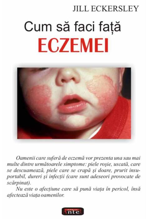 Copertă produs Cum să faci faţă eczemei