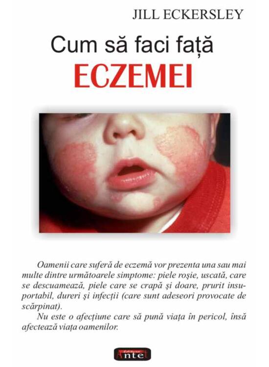Copertă produs Cum să faci faţă eczemei - gallery big 1